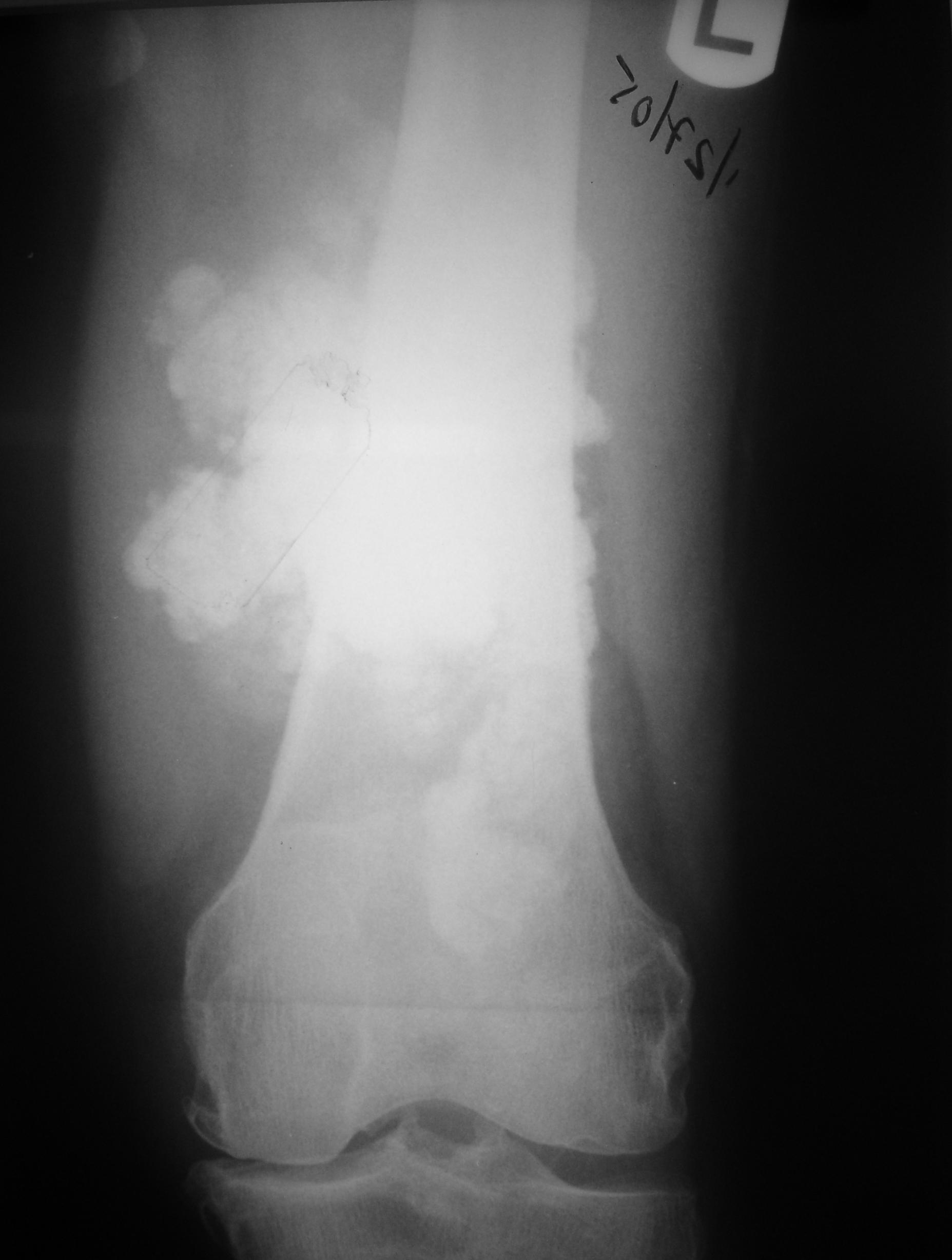 extraskeletal-osteosarcoma-soft-tissue-osteosarcoma